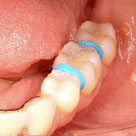 Brace Tooth filling